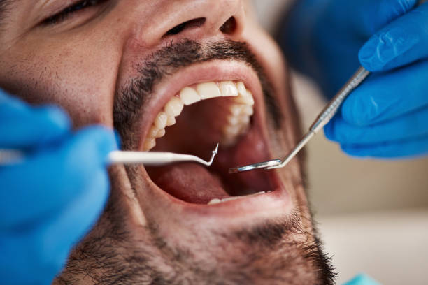 Best Emergency Dentist for Lost Fillings or Crowns in Stiles, PA